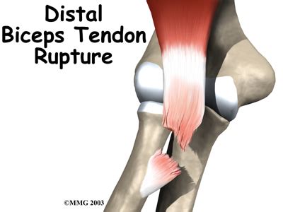 right distal biceps tendon rupture